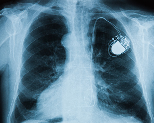 Cardiac Pacing