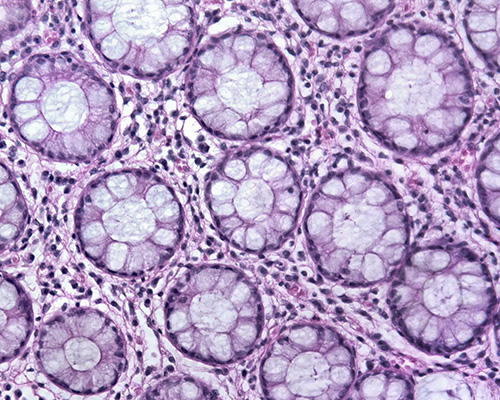 Extreme Temperature Ablation