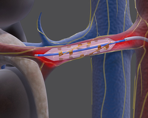 Renal Denervation