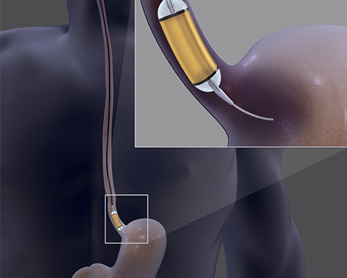 Esophageal Dilation