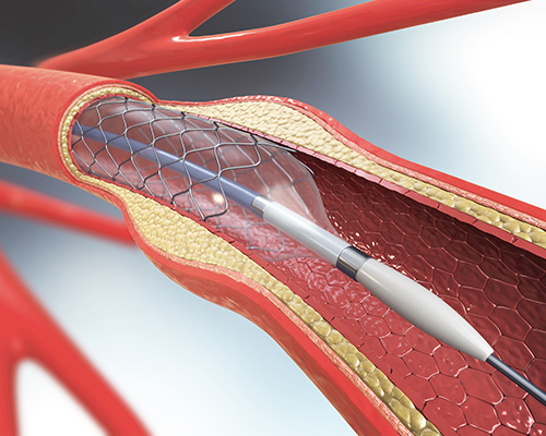 Balloon Angioplasty