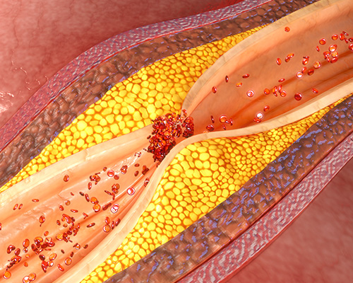 Embolic Filtration