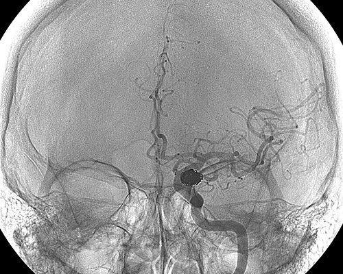 Neuroembolization