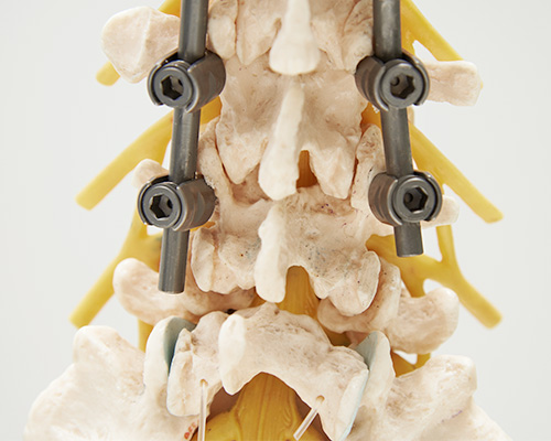 Spinal Fusion