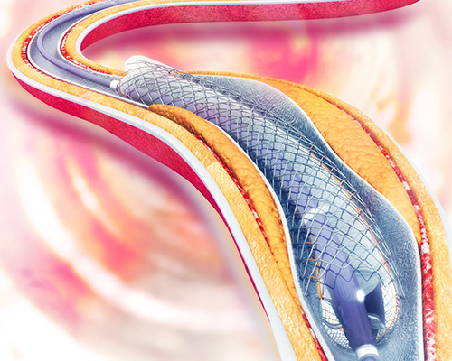 Peripheral Angioplasty