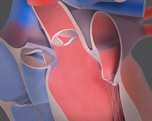 Transcatheter Aortic Valve Implantation/Repair