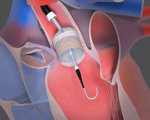 Transcatheter Mitral Valve Replacement and Repair (TMVR)