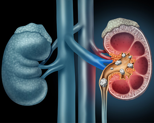 Laser Lithotripsy