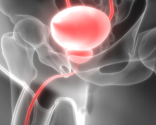 Radical Prostatectomy