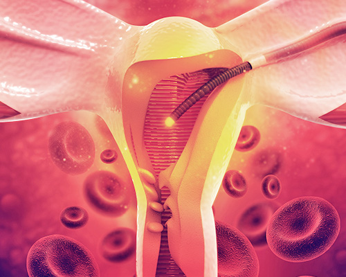 Uterine Artery Embolization